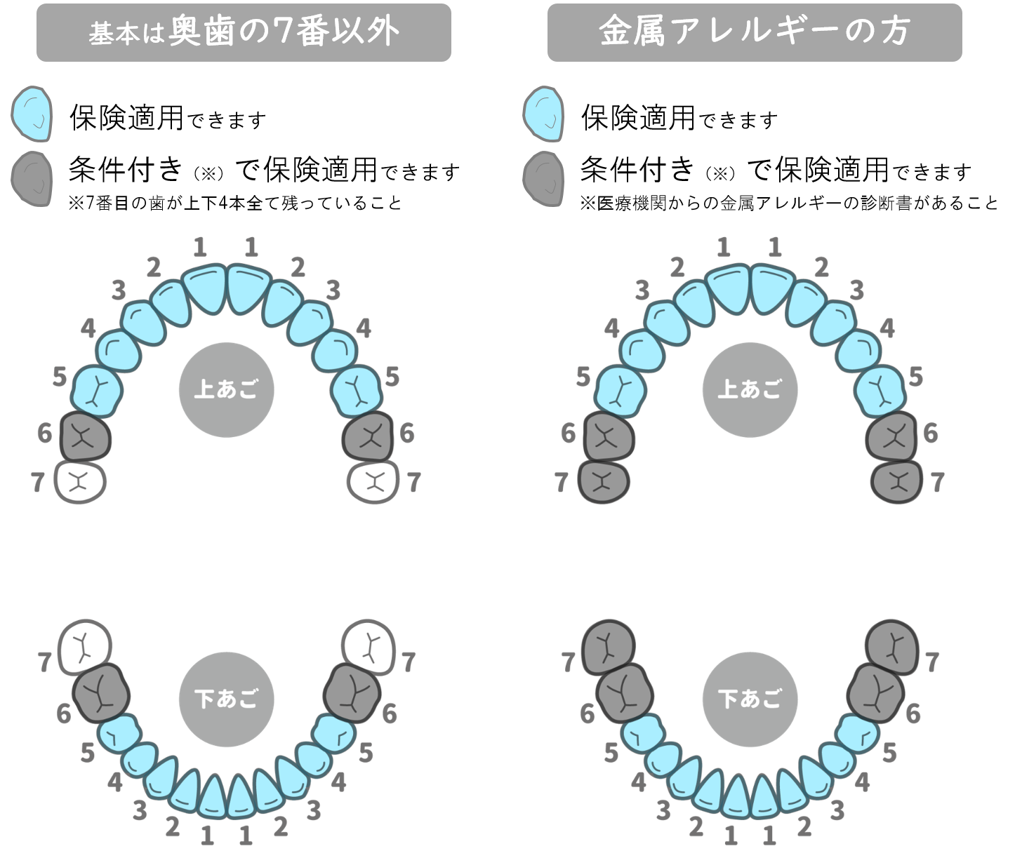 インターパーク（宇都宮・雀宮）の歯医者、こうだい歯科で保険診療でも「白い歯」に